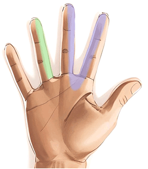 Handkirurgiskt diagnosstöd: skador på fingernerv