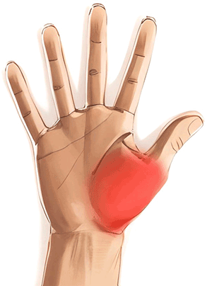 Handkirurgiskt diagnosstöd: tumbasartros