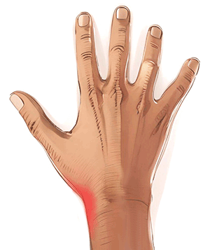 Handkirurgiskt diagnosstöd: mb de quervain