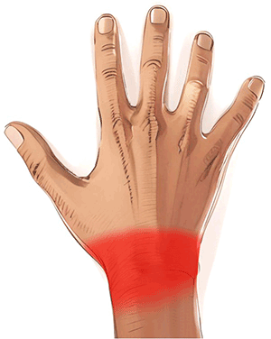 Handkirurgiskt diagnosstöd: restsymtom efter radiusfraktur