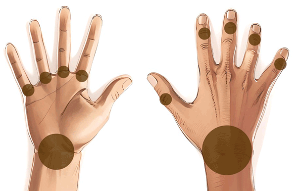 Handkirurgiskt diagnosstöd: knöl eler annan utbuktning