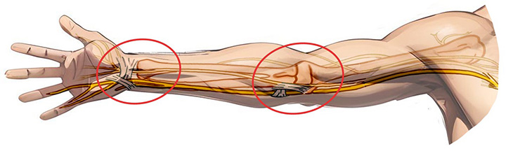 Ulnarisnervens anatomi och vanligaste områden för nervkompression