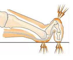 Illustration av fot med klotå