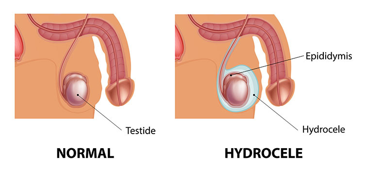 Normal testikel och testikel med hydrocele
