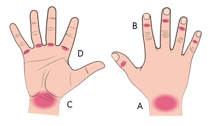 Ganglion på olika områden på händerna