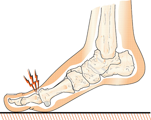 Illustration av fot med smärta på stortåledens ovansida.