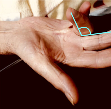 Kontraktur i MCP-led