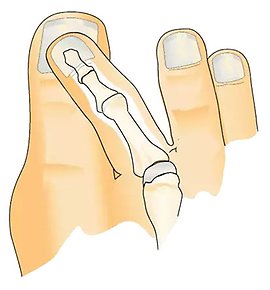 Illustration av fot med överridande tå