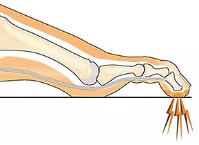 Illustration av fot med Mallettå