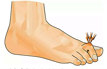 Illustration av fot med hammartå