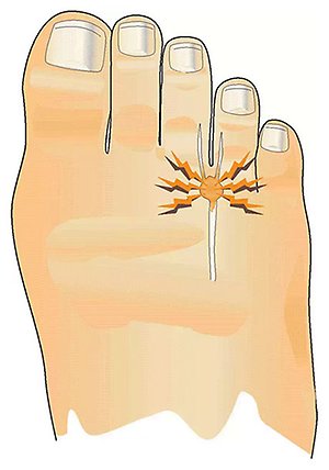 Illustration av fot med Mortons neuralgi med smärta mellan tredje och fjärde tån